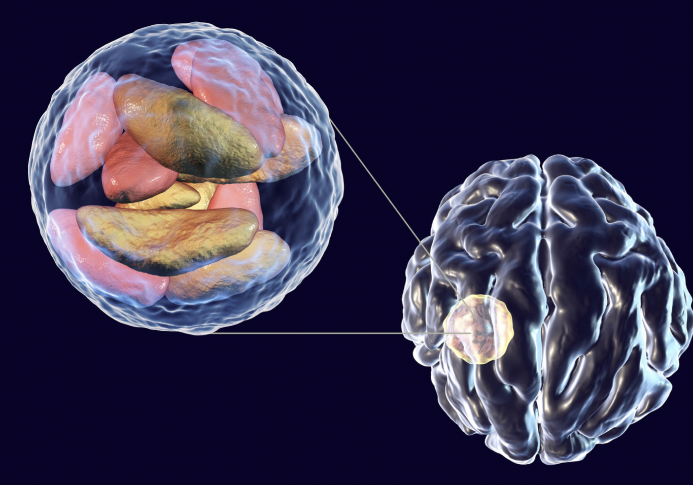 Toxoplasmosis Serebri